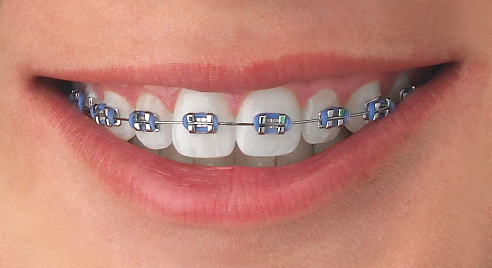 Dental Braces - Woodbine Danforth Dental Care