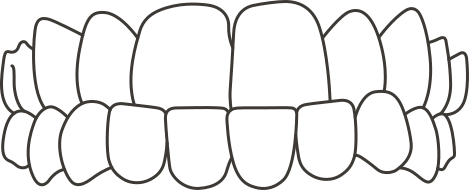 Underbite