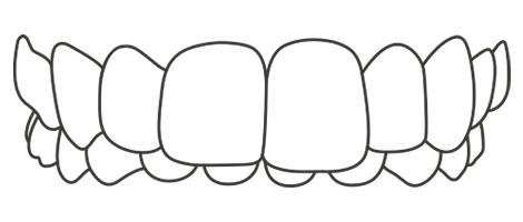 overbite