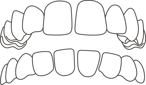 Gap-Teeth
