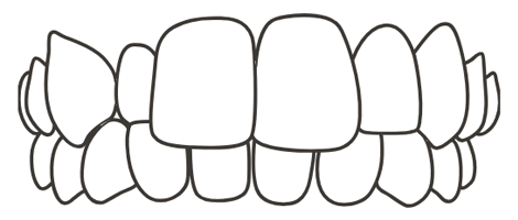 crossbite