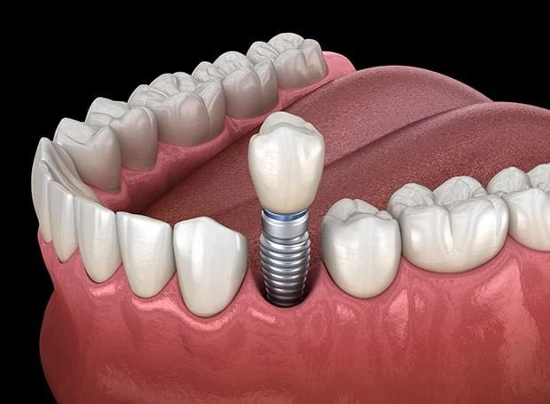 dental implant surgery