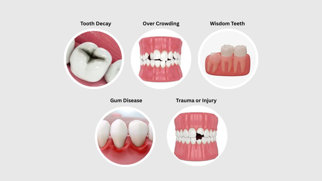 Tooth Extraction Reasons