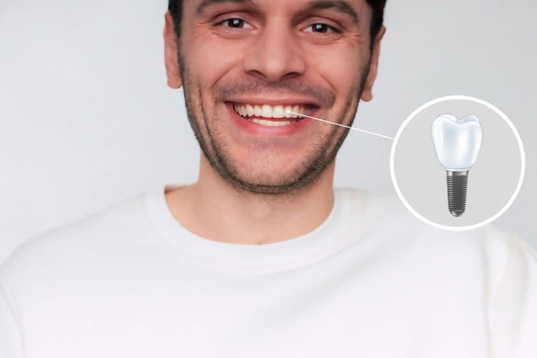 Dental Implants vs. Bridges: Which Tooth Replacement Lasts Longer?