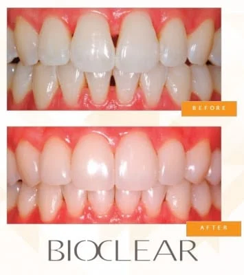 Bioclear